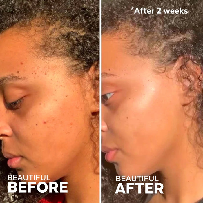 Three Ships In the Clear 3-Step Kit for Acne Prone Skin 1kit